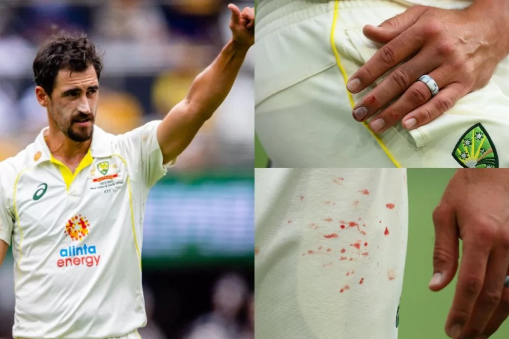 Mitchell Starc injury