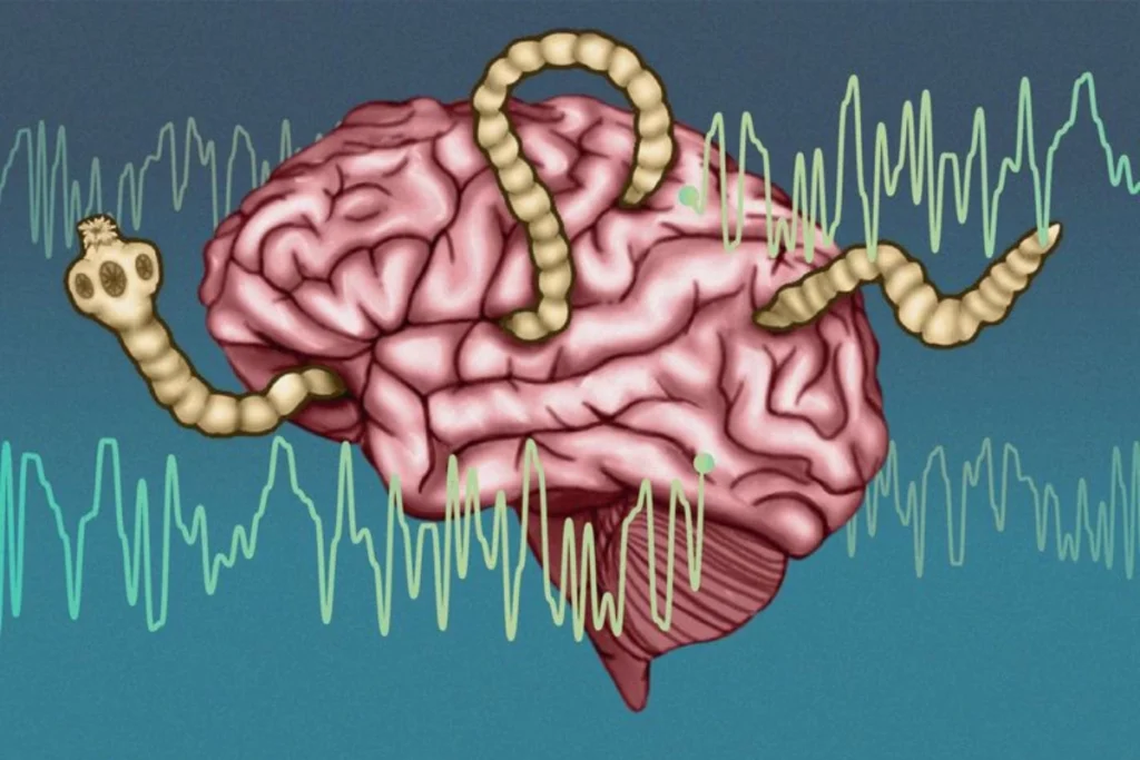 Neurocysticercosis