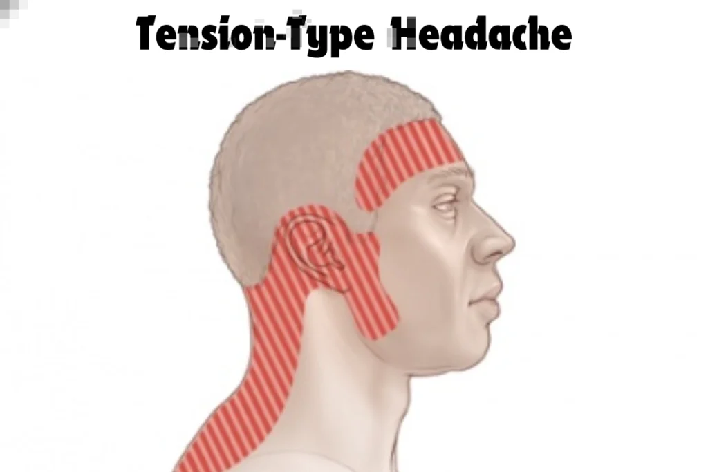 Tension Type Headache